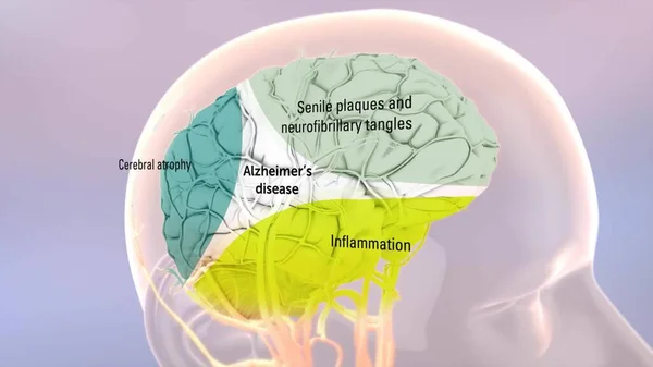 Cervello Umano Sano Cervello Con Malattia Alzheimer — Foto Stock