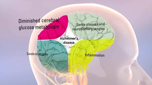 Cervello Umano Sano Cervello Con Malattia Alzheimer — Foto Stock