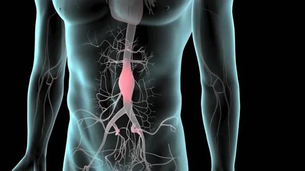 Abdominal aort anevrizması. Abdominal atardamar dolaşım sistemi. Abdominal aort ve anevrizmalı karın aortu sağlıklı. Siyah arkaplanda izole edilmiş düz biçim illüstrasyon