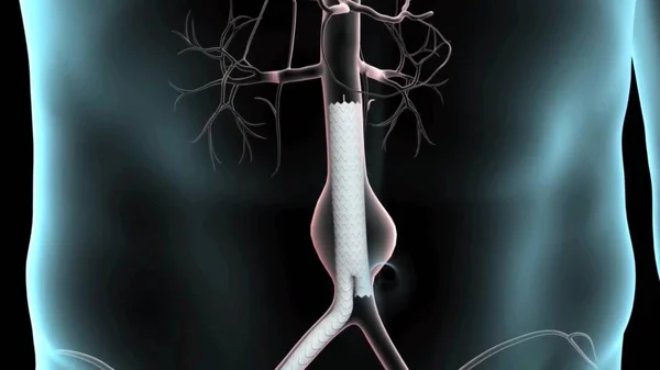 Aneurisma Aorta Abdominal Sistema Circulatório Arterial Abdômen Aorta Abdominal Saudável — Fotografia de Stock