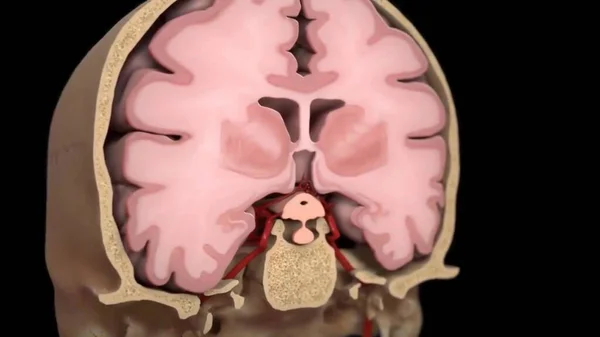 Imagem Cintilografia Paciente Traumático Com Lesão Cerebral Mostrando Contusão Cerebral — Fotografia de Stock