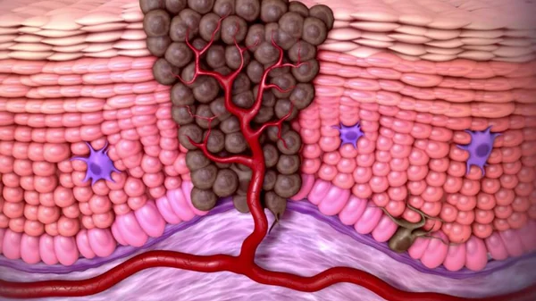 Melanoma or skin cancer. layers of the human skin.