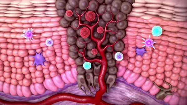 Μελάνωμα Καρκίνος Του Δέρματος Στρώματα Του Ανθρώπινου Δέρματος — Φωτογραφία Αρχείου