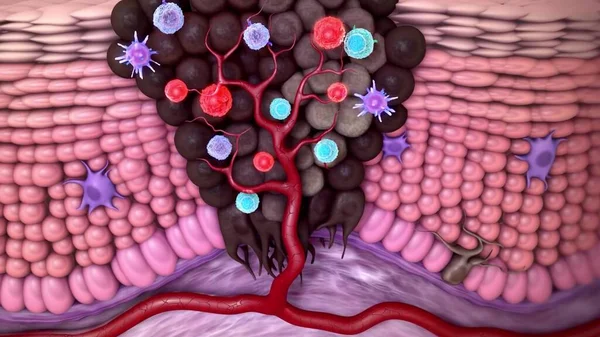 Melanoma or skin cancer. layers of the human skin.