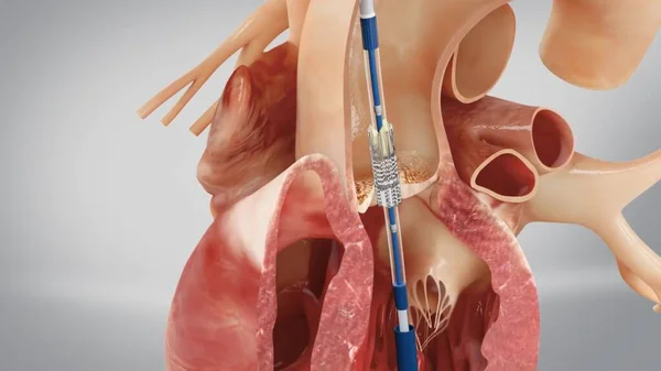 人工義肢大動脈弁の心臓への人工人工義肢大動脈弁の人工人工義肢手術アタッチメント — ストック写真