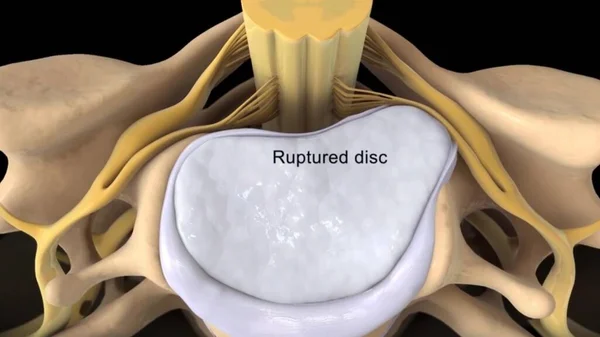 Omurgada dejeneratif bir hastalık olan omurilik sıkışması, omurga sinirlerinin tıbbî konseptini 3 boyutlu bir illüstrasyon olarak oluşturur..
