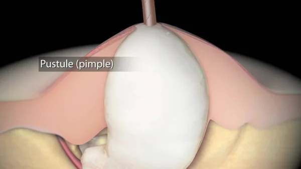 Acne And Pimples, Stages Of Development, Graphic Animation