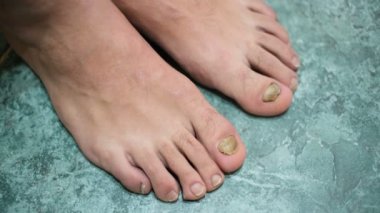 Genç adam yalınayak hasta onycho mycosis tırnaklı, dermatolojik tıbbi hastalık, sağlık problemi 