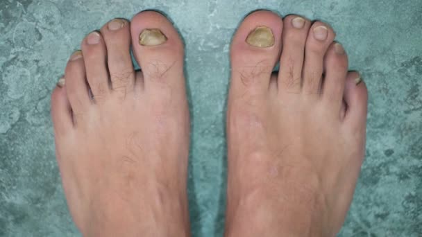 Jonge man op blote voeten vingers met zieke onycho mycose nagels, dermatologische medische ziekte, gezondheidsprobleem — Stockvideo