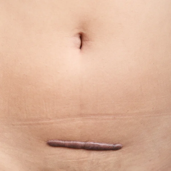 Fotos de cicatriz de histerectomia abdominal