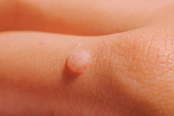 Common wart Verruca vulgaris a flat wart commonly found on the hand of children and adults. They are caused by a type of human papillomavirus HPV. — Stock Photo, Image