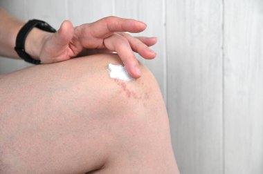 Bir kadın yaralı dizine sıcak bir merhem sürüyor. Diz ekleminde çürükler var..