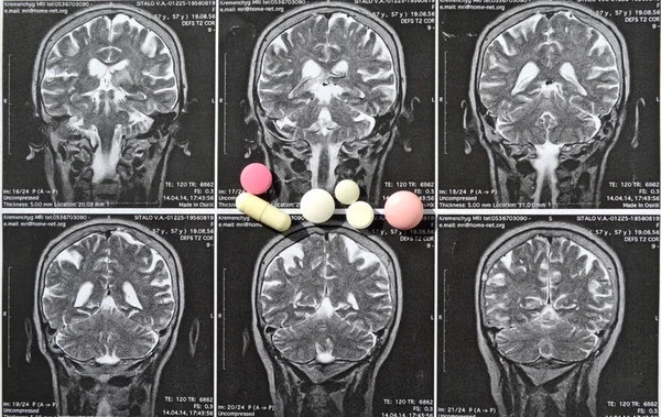 Picture of a brain hemorrhage stroke — Stock Photo, Image