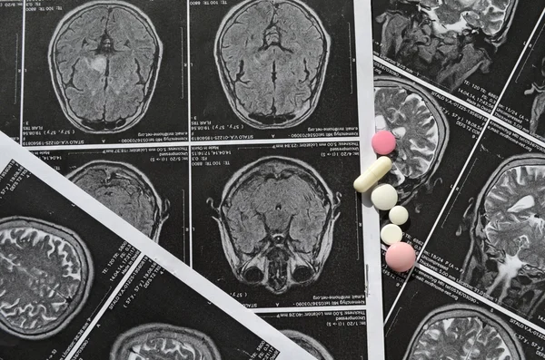 Picture of a brain hemorrhage stroke — Stock Photo, Image