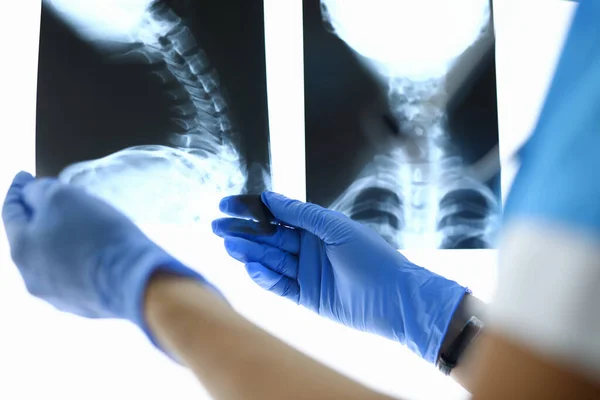 Médicos manos sosteniendo rayos X de columna cervical. — Foto de Stock