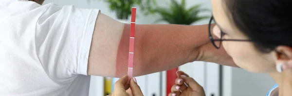 Verpleegster bepaalt de mate van zonnebrand op de arm. — Stockfoto