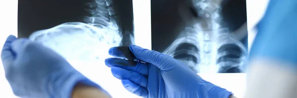 Medici mani che tengono i raggi X della colonna vertebrale cervicale. — Foto Stock