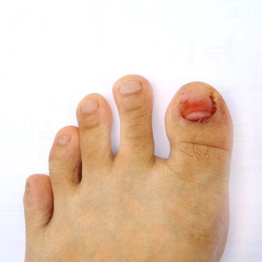 finger toe injured to lose nail clipart