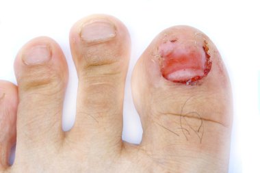 çivi kaybetmek yaralı parmak ayak