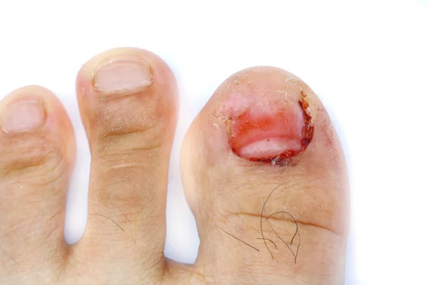 çivi kaybetmek yaralı parmak ayak