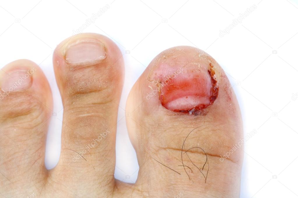 finger toe injured to lose nail