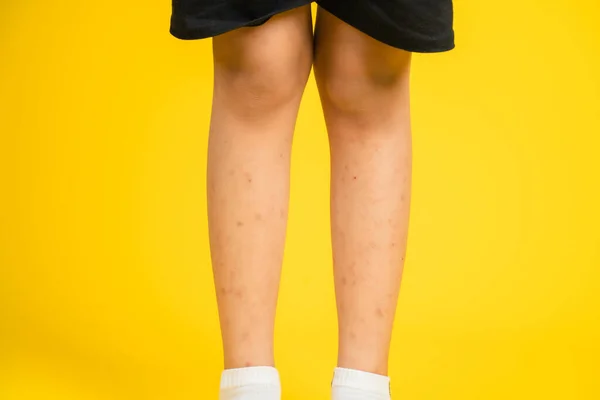 Foto Pierna Una Niña Con Cicatrices Fondo Color Cicatrices Alérgicas —  Fotos de Stock