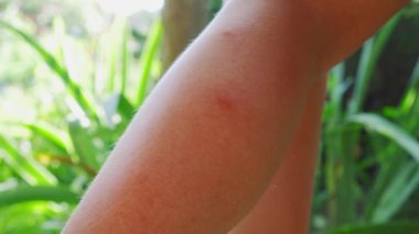 Bacağında kırmızı ısırık izi var. Kaşıntı ve iltihap. Yarayı elinle kaşı..