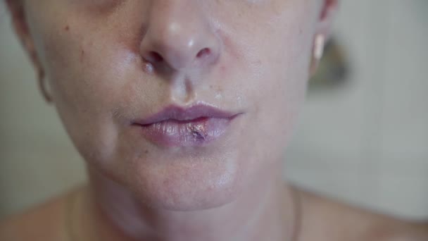 Dermatologische Ziekte Herpes Lippen Van Een Vrouw Virale Infectie Blaren — Stockvideo