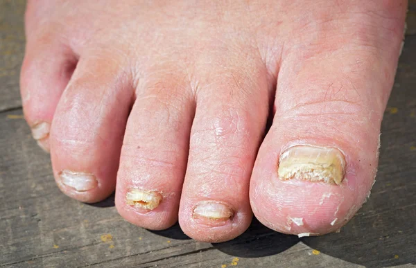 Грибковая инфекция на ногтях ног человека — стоковое фото