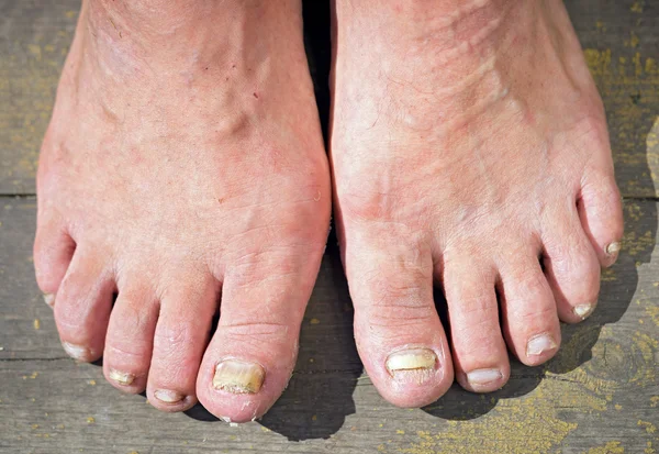 Onychomycosis with fungal nail infection — Stock Photo, Image