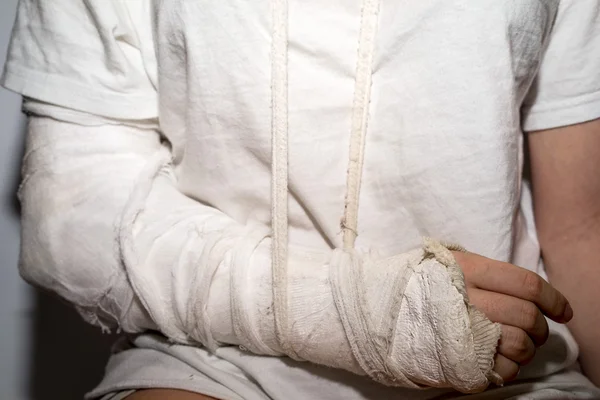 Mujer con el brazo roto en un yeso blanco sucio — Foto de Stock