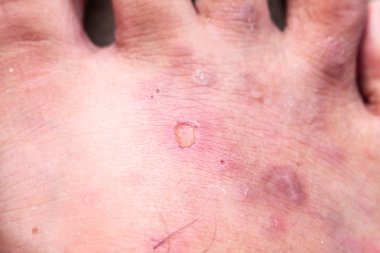 Portre deri sporcular ayak sedef mantarı, hong kong ayak, ayak hastalığı