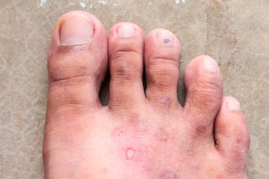 Portre deri sporcular ayak sedef mantarı, hong kong ayak, ayak hastalığı