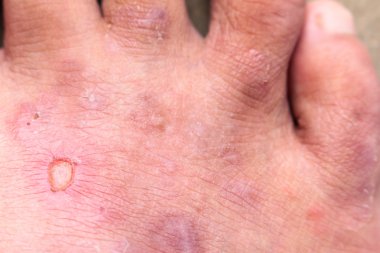 Portre deri sporcular ayak sedef mantarı, hong kong ayak, ayak hastalığı