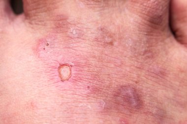 Portre deri sporcular ayak sedef mantarı, hong kong ayak, ayak hastalığı