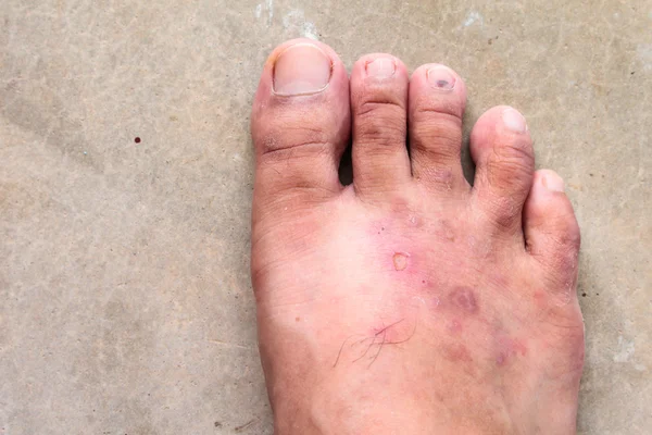 Primo piano atleti della pelle piede fungo psoriasi, Hong Kong piede, malattia del piede — Foto Stock