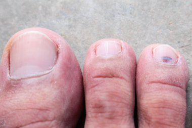 Portre deri sporcular ayak sedef mantarı, hong kong ayak, ayak hastalığı