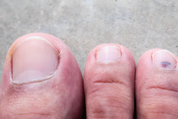 Primer plano de la piel atletas pie psoriasis hongo, hong kong pie, enfermedad del pie — Foto de Stock