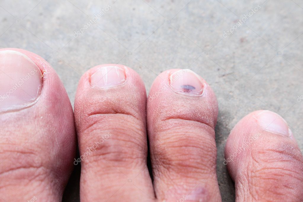 Primer plano de la piel atletas pie psoriasis hongo, hong kong pie