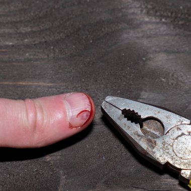 İş yerinde yaralanma, elinde kanla büyük bir baş parmak, bir adam penseyle parmağını yaraladı ve burnunu kanayarak kırdı..