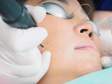 Asian woman patient on laser procedure skin resurfacing in aesthetic medicine. clipart