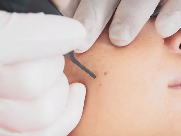 Asiatische Patientin im Laserverfahren Haut, die in der ästhetischen Medizin wieder auftaucht. — Stockfoto