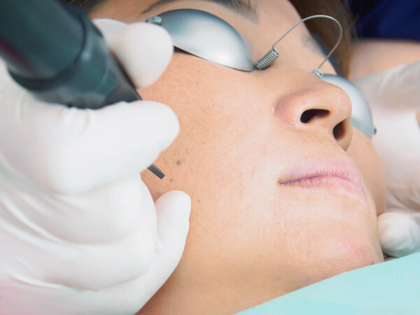 Asian woman patient on laser procedure skin resurfacing in aesthetic medicine.