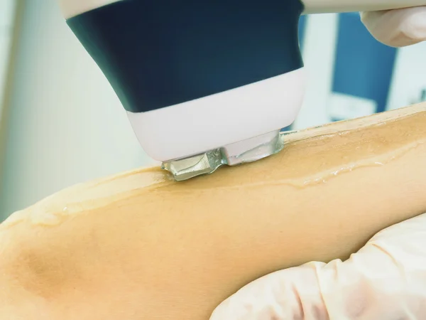 Laser haar arm verwijdering epileren. Behandeling in Cosmeticastudio. — Stockfoto