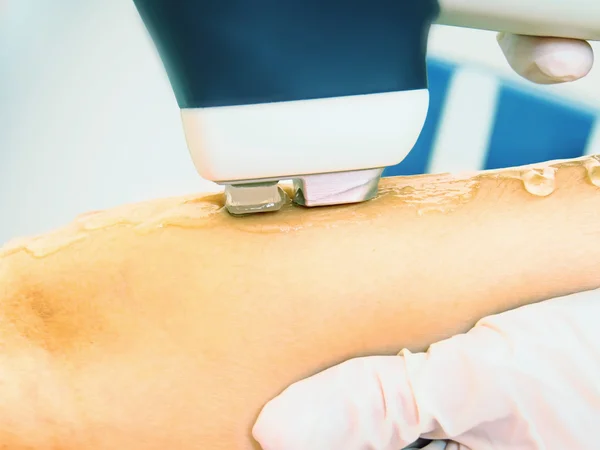 Laser haar arm verwijdering epileren. Behandeling in Cosmeticastudio. — Stockfoto