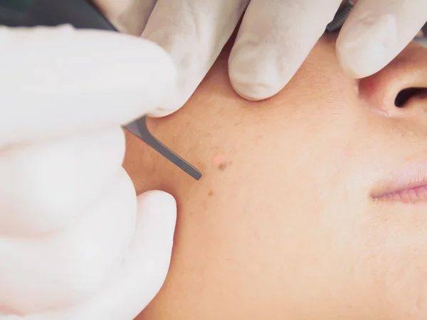 Aziatische vrouw patiënt op laser procedure huid resurfacing in de esthetische geneeskunde. Stockfoto