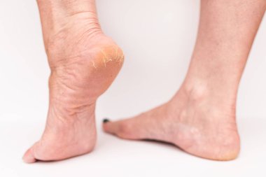 Kadın topuğunda yakın çekim çatlakları var. Beyaz arka plan izole edilmiş. Sağlık kavramı..