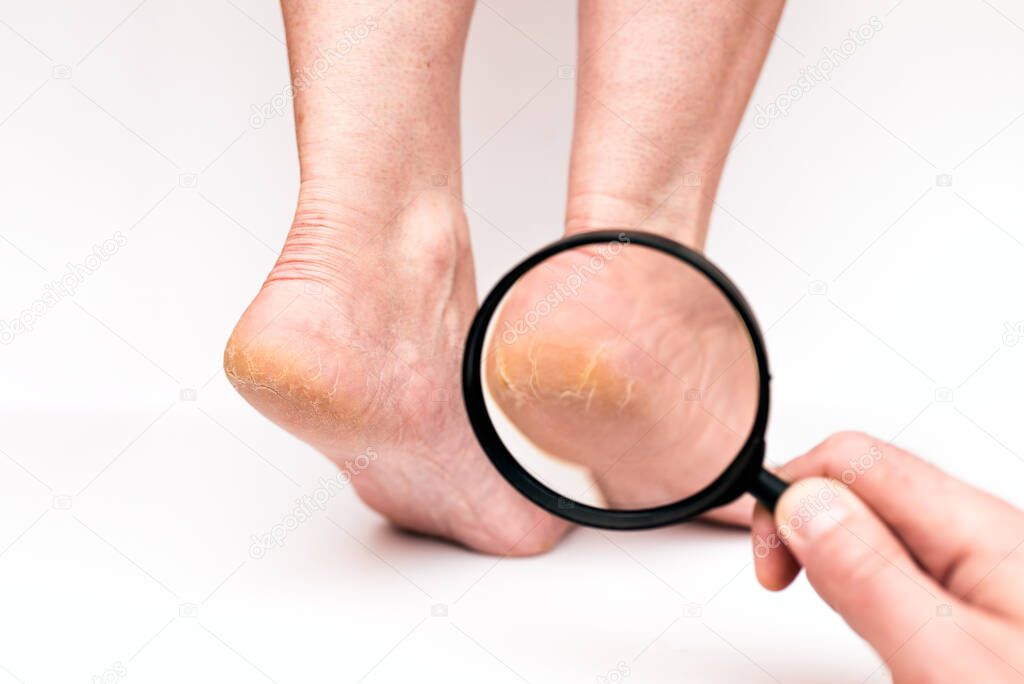 Closeup Highly dry heels woman on a white background through a magnifying glass.The doctors hand checks on how much cracked the skin is.