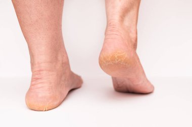 Kadın topuğunda yakın çekim çatlakları var. Beyaz arka plan izole edilmiş. Sağlık kavramı..