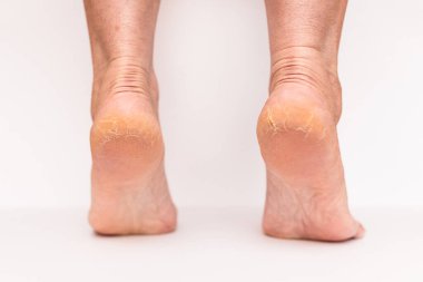 Kadın topuğunda yakın çekim çatlakları var. Beyaz arka plan izole edilmiş. Sağlık kavramı..